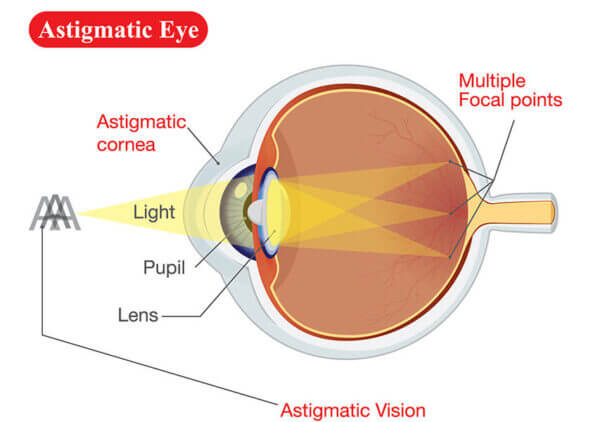 Laser Cataract Surgery Utica | Cataract New Hartford | CNY Eye